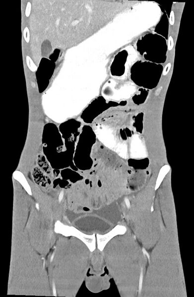 File:Blunt injury to the small bowel (Radiopaedia 74953-85987 B 32).jpg