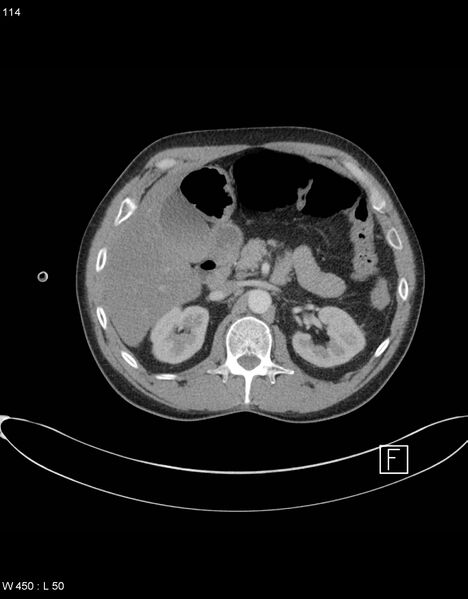 File:Boerhaave syndrome with tension pneumothorax (Radiopaedia 56794-63605 A 56).jpg