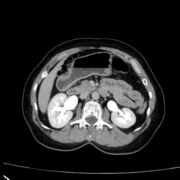 File:Bosniak renal cyst - type I (Radiopaedia 27479-27675 D 17).jpg