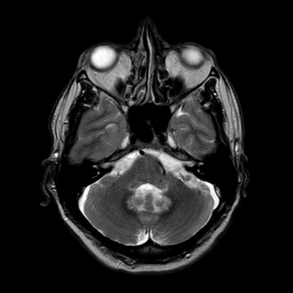 File:Brain abscess complicated by intraventricular rupture and ventriculitis (Radiopaedia 82434-96577 Axial T2 5).jpg