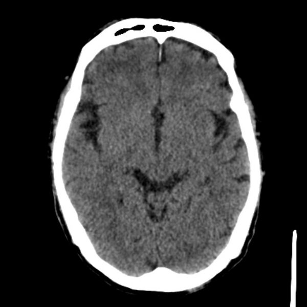 File:Brain metastases from lung cancer (Radiopaedia 27849-28092 Axial non-contrast 21).jpg