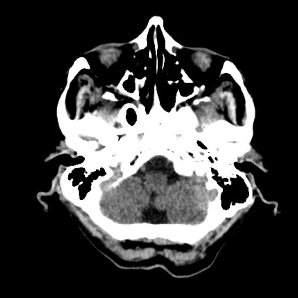 File:Brain metastases from lung cancer (Radiopaedia 27849-28092 Axial non-contrast 8).jpg