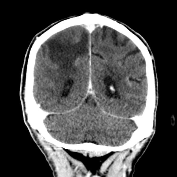 File:Brain metastases from lung cancer (Radiopaedia 27849-28092 Coronal C+ delayed 50).jpg