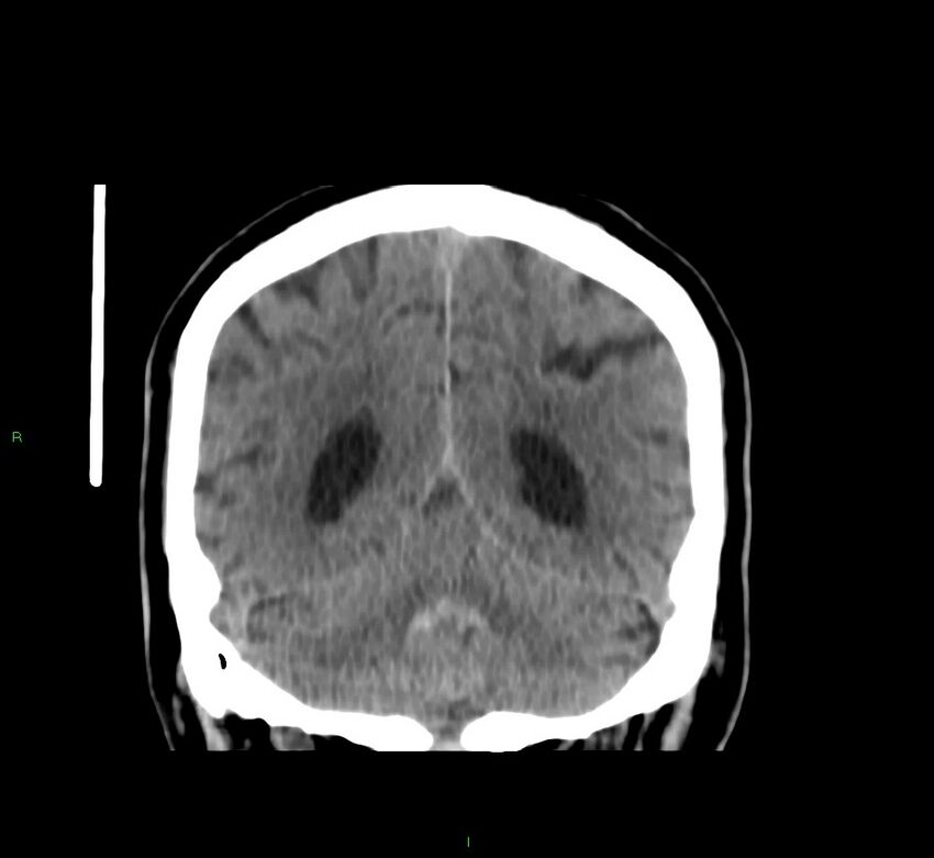 Brainstem hemorrhage (Radiopaedia 58794-66028 Coronal non-contrast 21).jpg