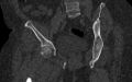 Breast carcinoma with pathological hip fracture (Radiopaedia 60314-67993 Coronal bone window 70).jpg