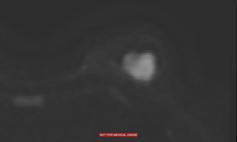 File:Breast lymphoma (MRI) (Radiopaedia 34999-36498 Axial DWI 9).jpg
