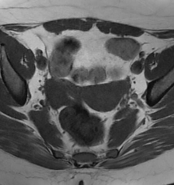 File:Broad ligament leiomyoma (Radiopaedia 81634-95516 Axial T1 11).jpg