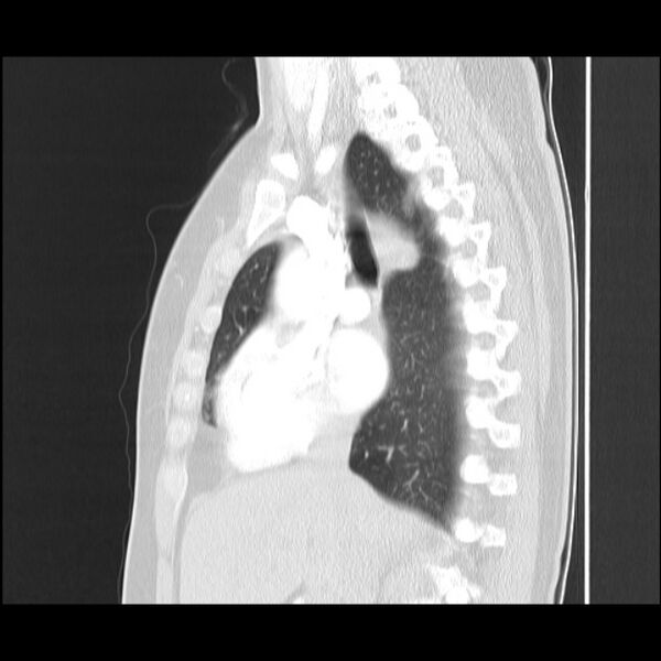 File:Bronchial atresia (Radiopaedia 22965-22992 Sagittal lung window 31).jpg
