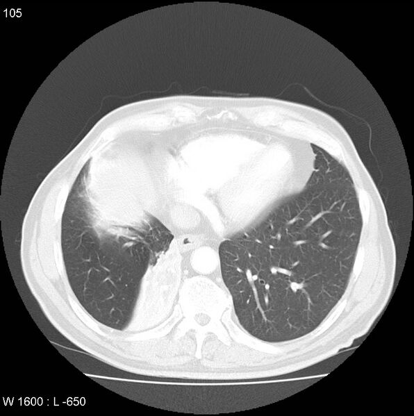 File:Bronchial carcinoid tumor with right lower lobe collapse (Radiopaedia 29060-29422 B 43).jpg