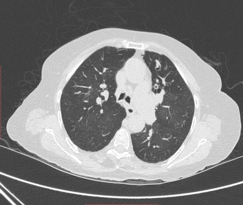 Bronchiectasis (Radiopaedia 72693-83293 Axial lung window 48).jpg