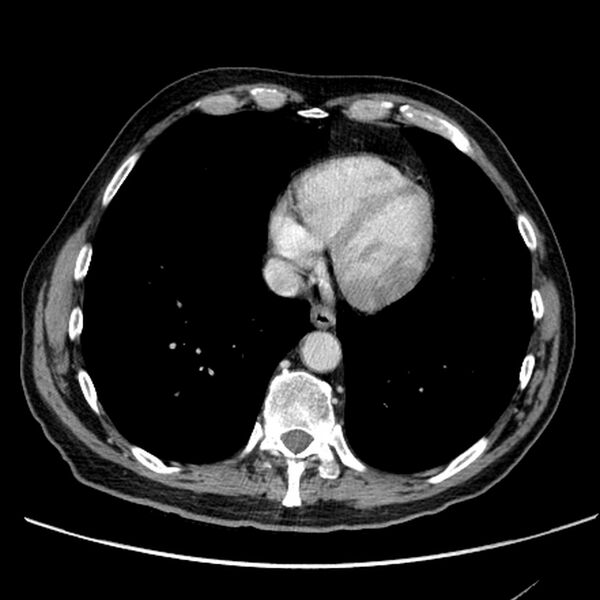File:Bronchogenic carcinoma with L1 vertebra metastasis (Radiopaedia 9096-9805 Axial C+ delayed 25).jpg