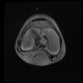 Bucket handle tear - lateral meniscus (Radiopaedia 72124-82634 Axial PD fat sat 9).jpg
