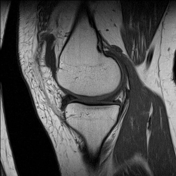 File:Bucket handle tear - medial meniscus (Radiopaedia 79028-91942 Sagittal T1 17).jpg