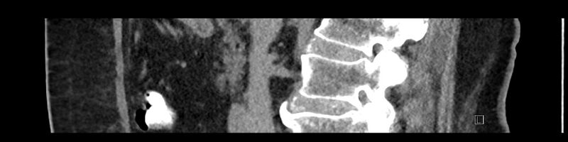 File:Buried bumper syndrome - gastrostomy tube (Radiopaedia 63843-72575 Sagittal Inject 69).jpg
