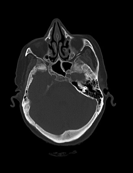 File:Burnt-out meningioma (Radiopaedia 51557-57337 Axial bone window 13).jpg
