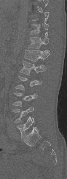 File:Burst fracture - T12 with conus compression (Radiopaedia 56825-63647 Sagittal bone window 29).png