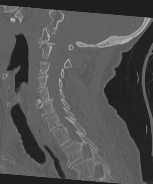 File:C2 fracture with vertebral artery dissection (Radiopaedia 37378-39199 Sagittal bone window 33).png