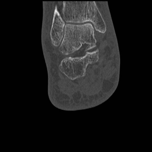 File:Calcaneal tuberosity avulsion fracture (Radiopaedia 22649-22668 Coronal bone window 50).jpg