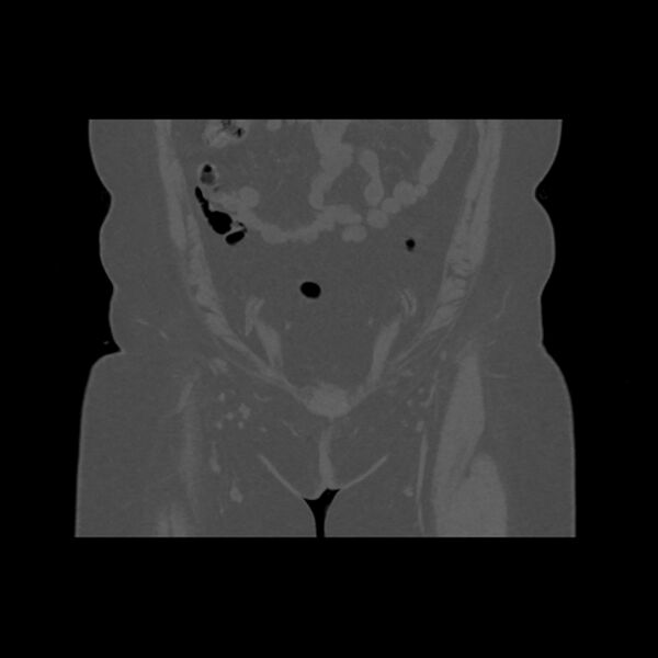 File:Calcific tendinitis of the gluteus medius muscle (Radiopaedia 66998-76318 Coronal bone window 7).jpg
