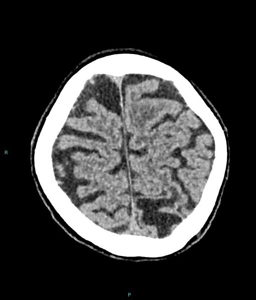 File:Calcified cerebral emboli from left ventricular thrombus (Radiopaedia 84420-99758 Axial non-contrast 20).jpg