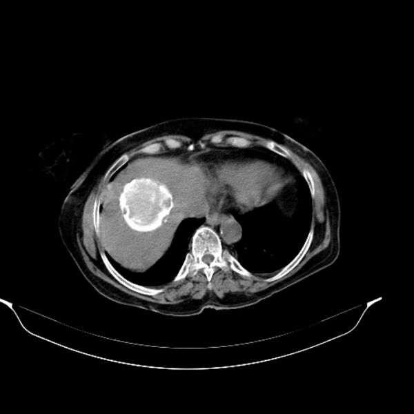 File:Calcified hydatid cyst (Radiopaedia 62000-70085 Axial non-contrast 18).jpg