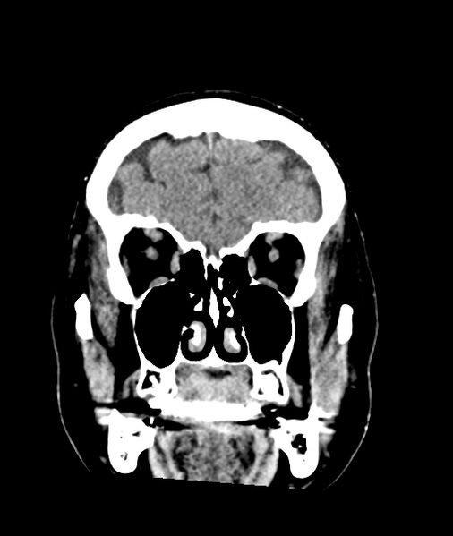 File:Calcified meningioma (Radiopaedia 74361-85243 Coronal non-contrast 8).jpg