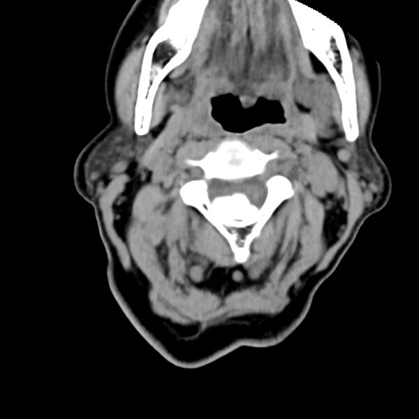 File:Calcified meningioma - cervical canal (Radiopaedia 70136-80171 B 11).jpg