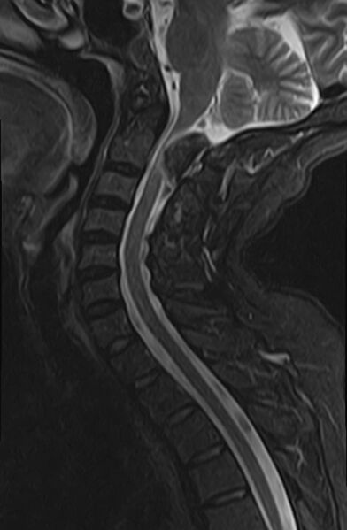 File:Calcified meningioma - cervical canal (Radiopaedia 70136-82468 Sagittal STIR 8).jpg
