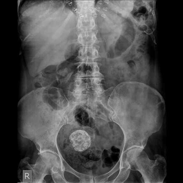 File:Calcified uterine leiomyoma (Radiopaedia 17561).JPEG