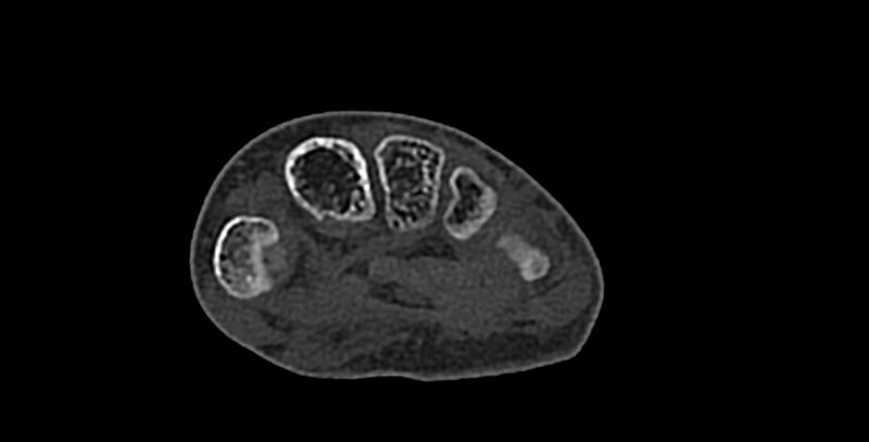 File:Calcifying aponeurotic fibroma (Radiopaedia 88423-105064 Axial bone window 125).jpg