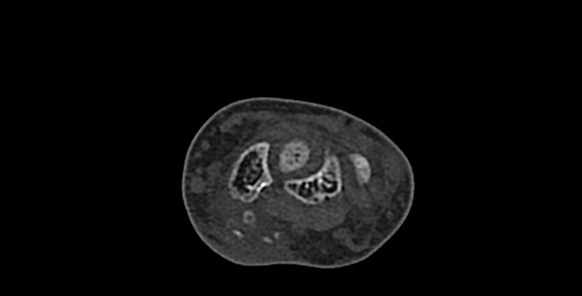 Calcifying aponeurotic fibroma (Radiopaedia 88423-105064 Axial bone window 62).jpg