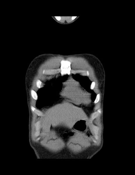 File:Calcifying pulmonary metastases (Radiopaedia 33359-34396 Coronal non-contrast 44).jpg