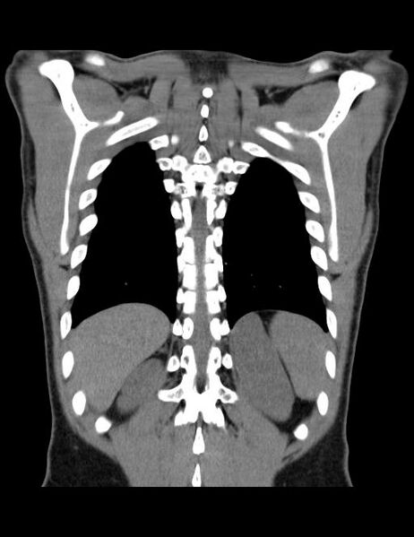 File:Calcifying pulmonary metastases (Radiopaedia 33359-34396 Coronal non-contrast 9).jpg