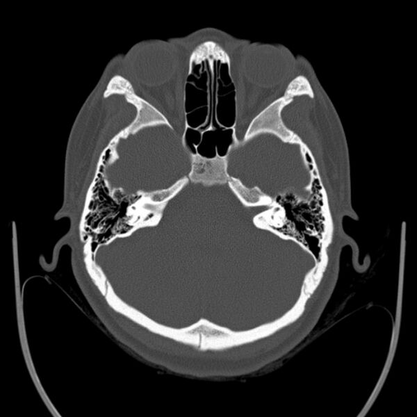 File:Calvarial osteoma (Radiopaedia 36520-38079 Axial bone window 29).jpg