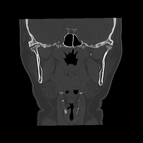 File:Canal up mastoidectomy (Radiopaedia 78108-90638 Coronal bone window 25).jpg