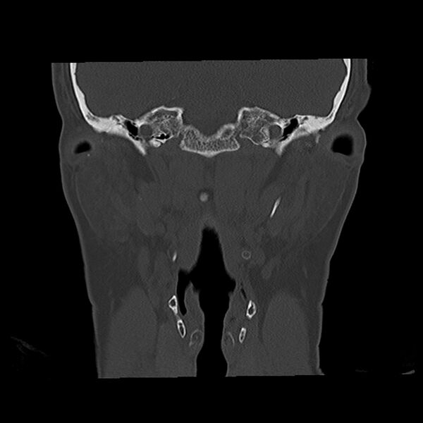 File:Canal up mastoidectomy (Radiopaedia 78108-90638 Coronal bone window 31).jpg