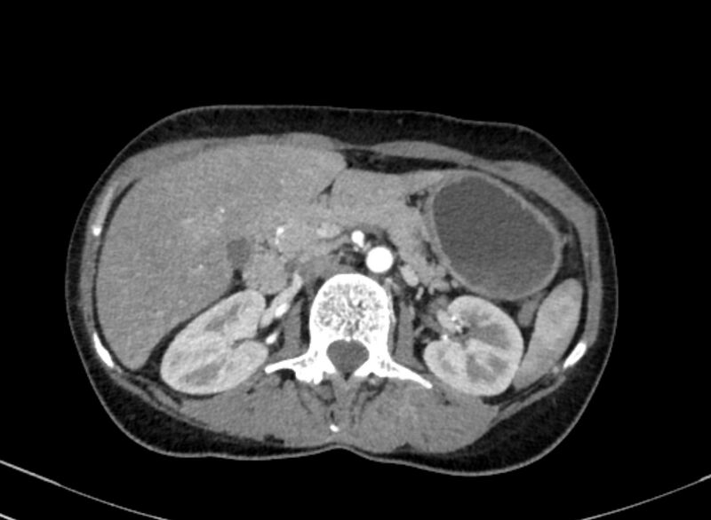 File:Cannonball metastases from breast cancer (Radiopaedia 91024-108569 A 135).jpg
