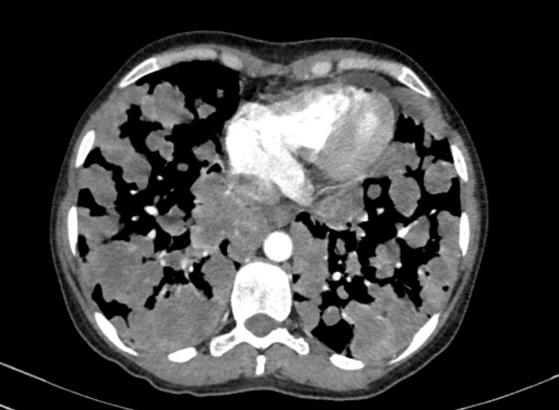 File:Cannonball metastases from breast cancer (Radiopaedia 91024-108569 A 91).jpg