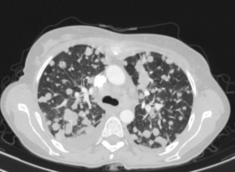File:Cannonball metastases from breast cancer (Radiopaedia 91024-108569 Axial lung window 31).jpg