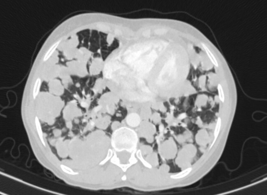 Cannonball metastases from breast cancer (Radiopaedia 91024-108569 Axial lung window 71).jpg