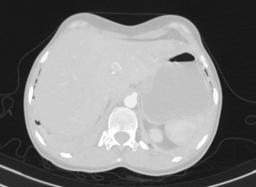 Cannonball metastases from breast cancer (Radiopaedia 91024-108569 Axial lung window 98).jpg