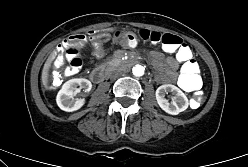 File:Carcinoid mesenteric tumor complicated by chylous ascites (Radiopaedia 76312-88926 A 35).jpg