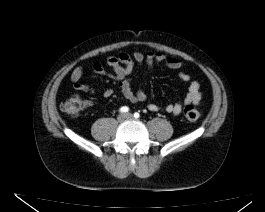 Carcinoid tumor with hepatic metastases (Radiopaedia 22651-22670 B 57).jpg