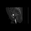 Carcinoma cervix- brachytherapy applicator (Radiopaedia 33135-34173 Sagittal bone window 79).jpg
