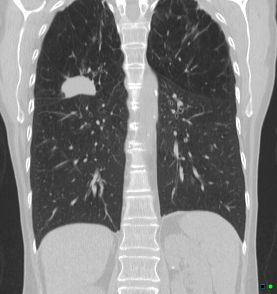 File:Carcinoma of the lung (Radiopaedia 17945-17705 Coronal lung window 1).jpg