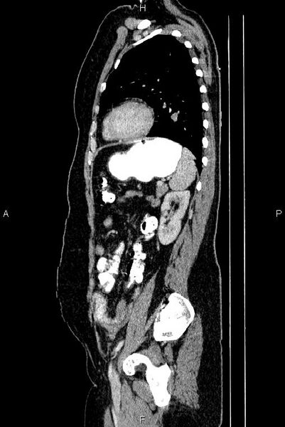 File:Carcinoma of uterine cervix (Radiopaedia 85861-101700 D 61).jpg