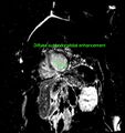 Cardiac amyloidosis (Radiopaedia 51404-57155 B 1).jpg