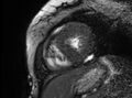 Cardiac amyloidosis (Radiopaedia 61600-69579 Short axis bSSFP 65).jpg