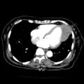 Cardiac fibroma (Radiopaedia 38974-41149 A 9).jpg