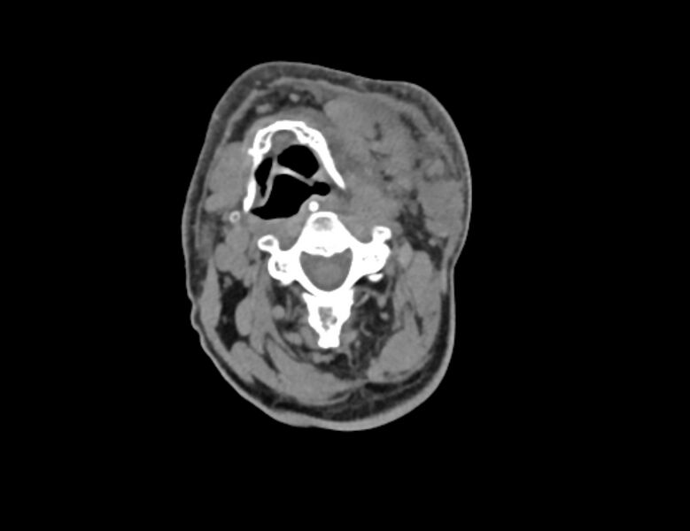 File:Carotid artery pseudoaneurysm (Radiopaedia 84030-99259 Axial non-contrast 18).jpg